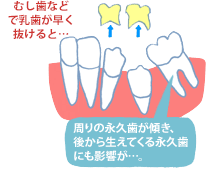 むし歯などで乳歯が速く抜けると…。周りの永久歯が傾き、後から生えてくる永久歯にも影響が…。