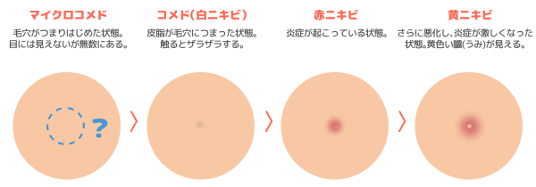 マイクロコメドは毛穴がつまりはじめた状態。目には見えないが無数にある　コメド(白ニキビ)は皮脂が毛穴につまった状態。触るとザラザラする。 赤ニキビは炎症が起こっている状態。　黄ニキビはさらに悪化し、炎症が激しくなった状態。黄色い膿(うみ)が見える。