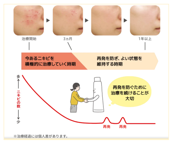 治療開始から3ヶ月は今あるニキビを積極的に治していく時期。3ヶ月目以降から一年以上は再発を防ぎよい状態を維持する時期　※治療経過には個人差があります。